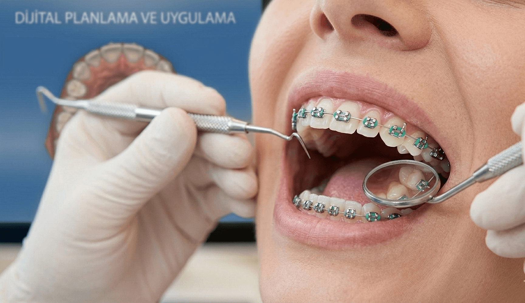 Ortodonti – Adana Seyhan'da Dt. İrem Bilge Güngör Diş Kliniği